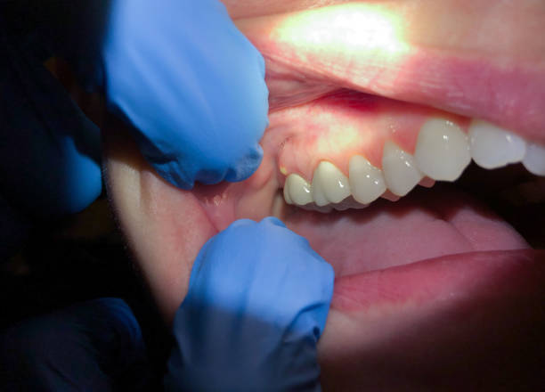 Best Emergency Dental Care for Broken or Chipped Teeth in Raymond, MS
